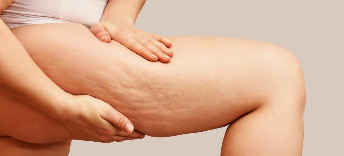 cellulite.jpg